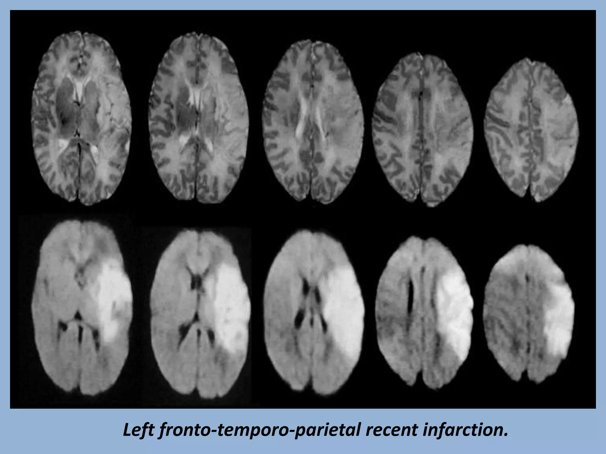Left fronto-temporo-parietal recent infarction.