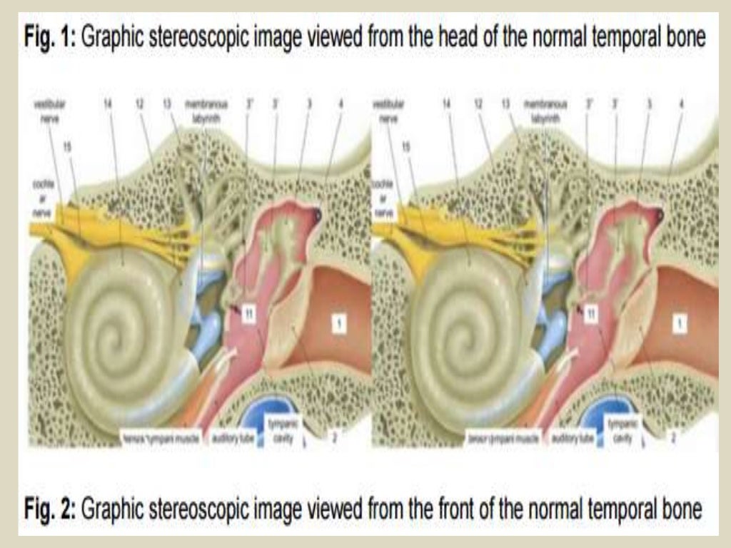 Presentation1.pptx, ct high resolution anatomy of the petrous bone.