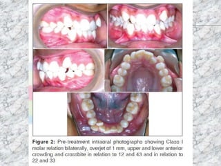 Torque in orthodontics