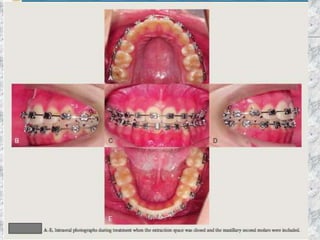 Torque in orthodontics