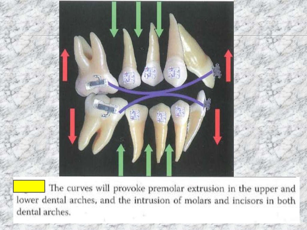 Torque in orthodontics