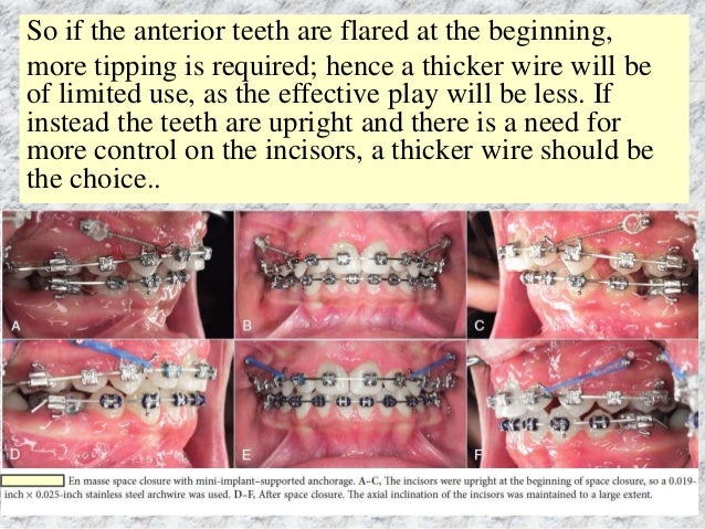 Braces Wire Thickness Chart