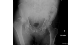 Photo Session: Posterior Hip Dislocation