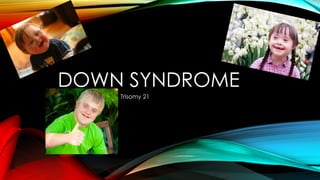 DOWN SYNDROME
Trisomy 21
 
