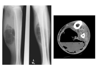 Imaging of musculoskeletal infections | PPTX