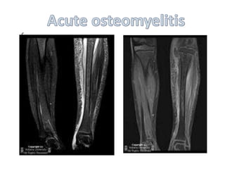 Imaging of musculoskeletal infections | PPTX