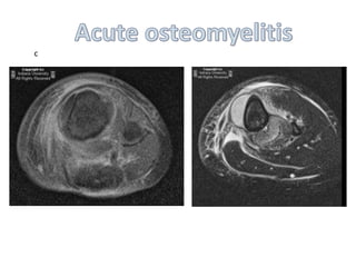 Imaging of musculoskeletal infections | PPTX