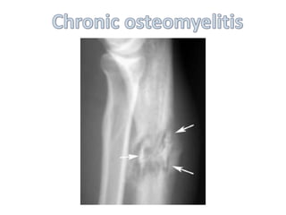 Imaging of musculoskeletal infections | PPTX
