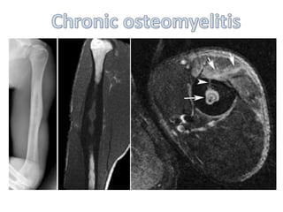 Imaging of musculoskeletal infections | PPTX