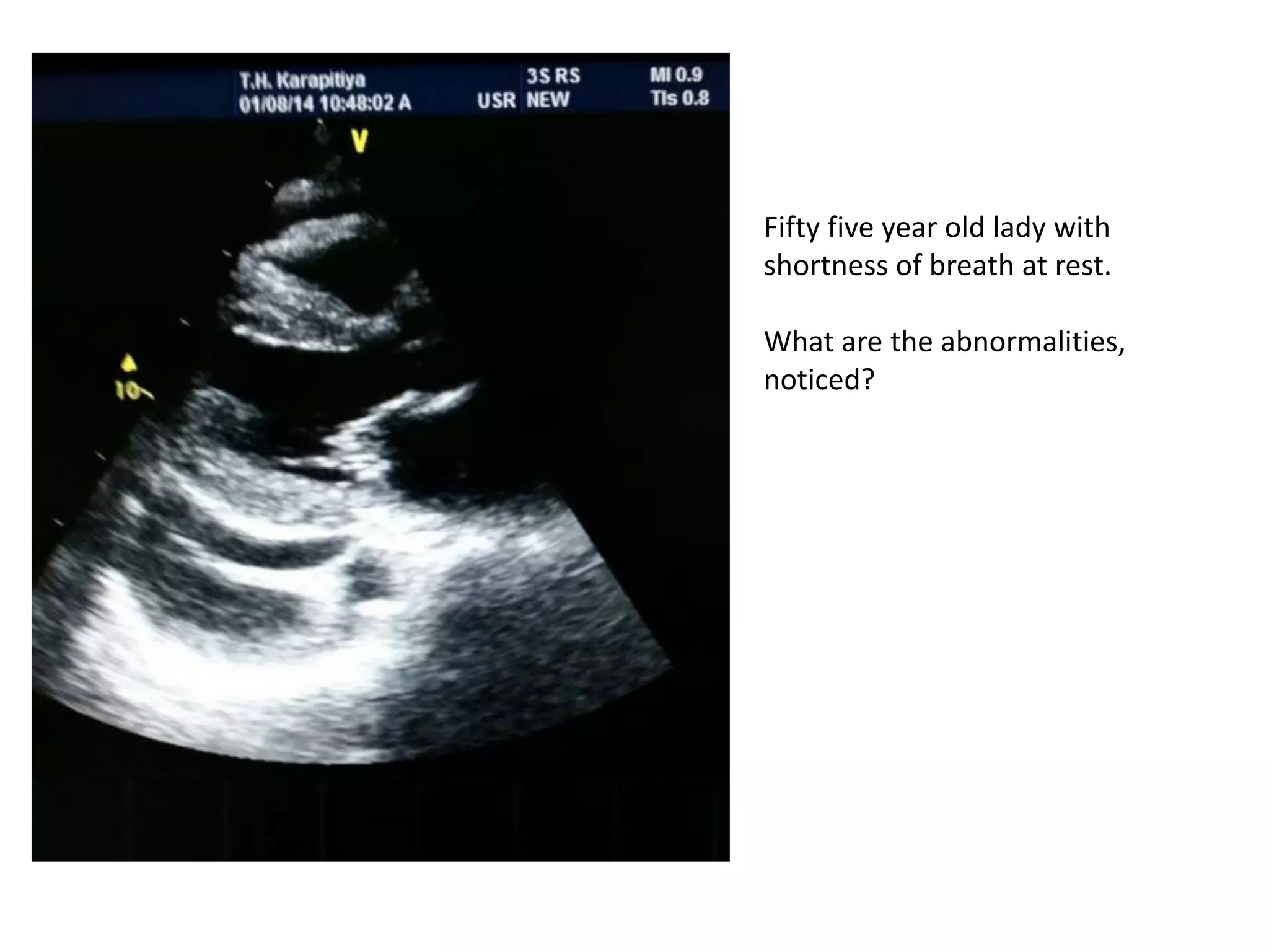 Fifty five year old lady with
shortness of breath at rest.
What are the abnormalities,
noticed?
 