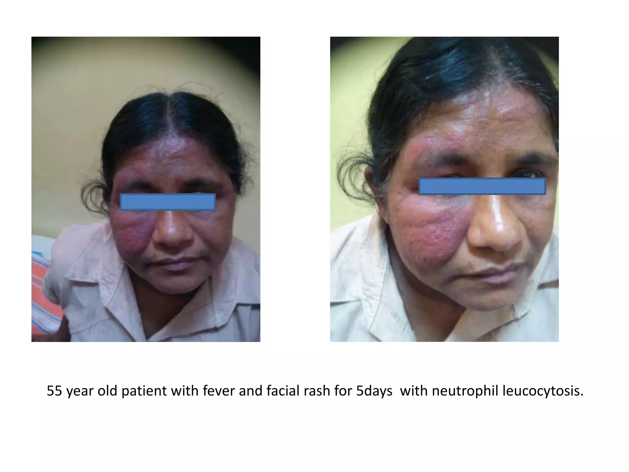 55 year old patient with fever and facial rash for 5days with neutrophil leucocytosis.
 