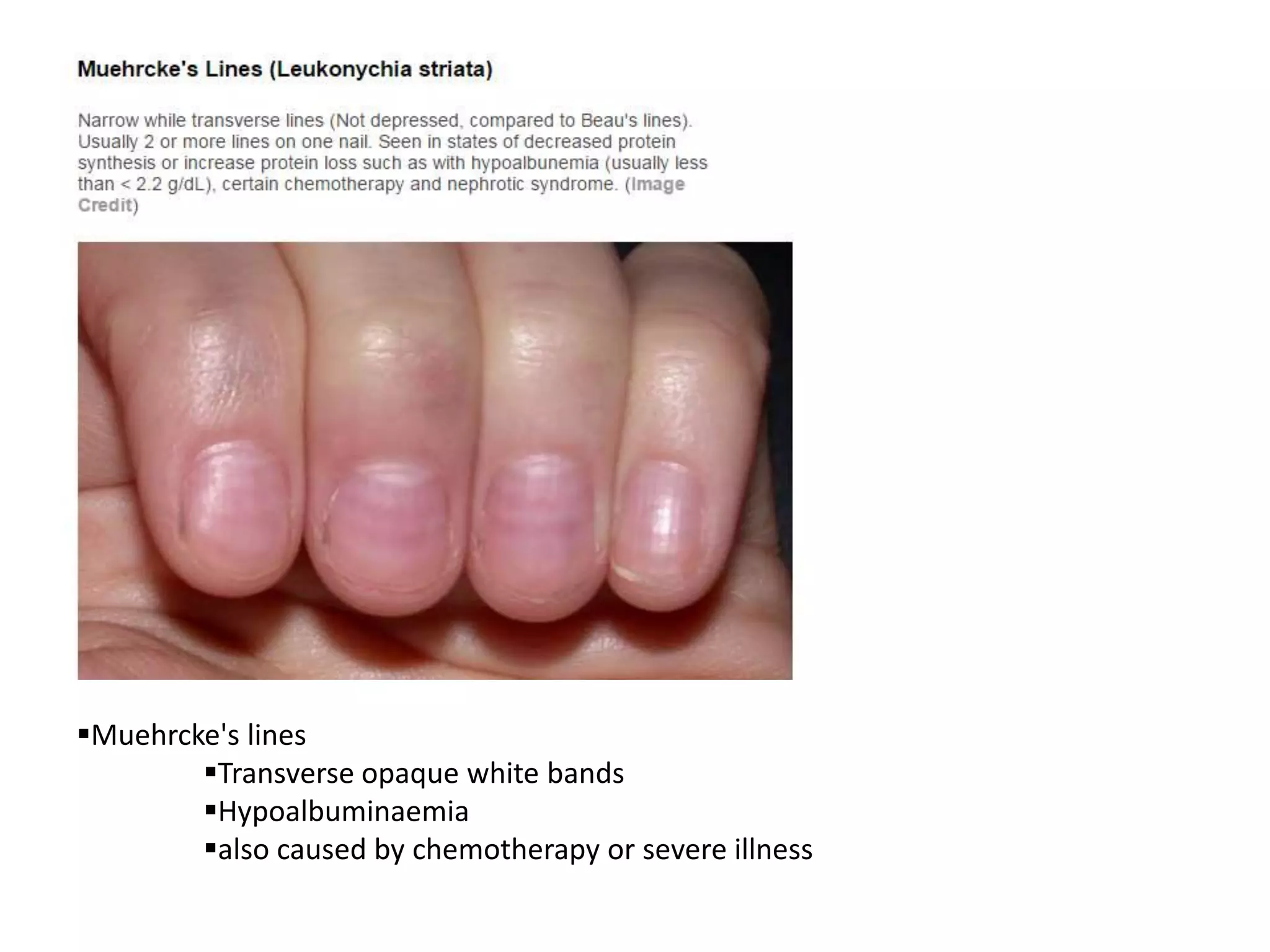 Muehrcke's lines
Transverse opaque white bands
Hypoalbuminaemia
also caused by chemotherapy or severe illness
 