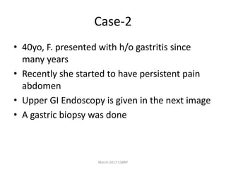 Case-2
• 40yo, F. presented with h/o gastritis since
many years
• Recently she started to have persistent pain
abdomen
• Upper GI Endoscopy is given in the next image
• A gastric biopsy was done
March-2017-CSBRP
 