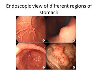 Endoscopic view of different regions of
stomach
March-2017-CSBRP
 