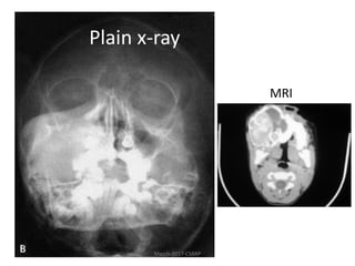 Plain x-ray
MRI
March-2017-CSBRP
 
