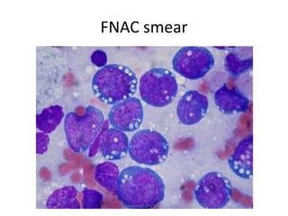 FNAC smear
March-2017-CSBRP
 