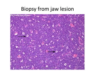 Biopsy from jaw lesion
March-2017-CSBRP
 