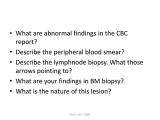 • What are abnormal findings in the CBC
report?
• Describe the peripheral blood smear?
• Describe the lymphnode biopsy. What those
arrows pointing to?
• What are your findings in BM biopsy?
• What is the nature of this lesion?
March-2017-CSBRP
 