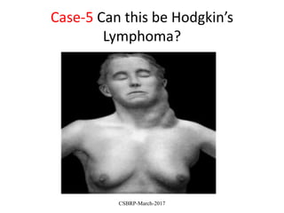 Case-5 Can this be Hodgkin’s
Lymphoma?
CSBRP-March-2017
 