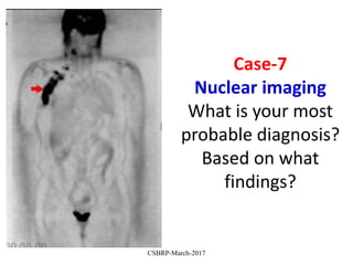 Case-7
Nuclear imaging
What is your most
probable diagnosis?
Based on what
findings?
CSBRP-March-2017
 