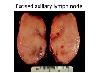 Excised axillary lymph node
March-2017-CSBRP
 