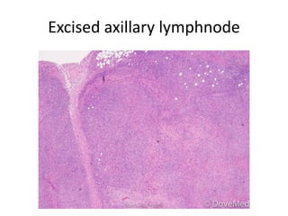 Excised axillary lymphnode
March-2017-CSBRP
 