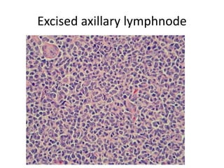Excised axillary lymphnode
March-2017-CSBRP
 
