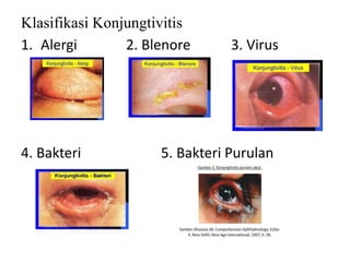 Klasifikasi Konjungtivitis
1. Alergi 2. Blenore 3. Virus
4.
4. Bakteri 5. Bakteri Purulan
 
