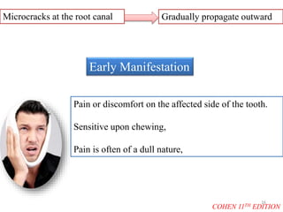 Early Manifestation
Microcracks at the root canal Gradually propagate outward
Pain or discomfort on the affected side of the tooth.
Sensitive upon chewing,
Pain is often of a dull nature,
COHEN 11TH EDITION
16
 