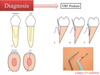Diagnosis VRF Pockets
COHEN 11TH EDITION
21
 
