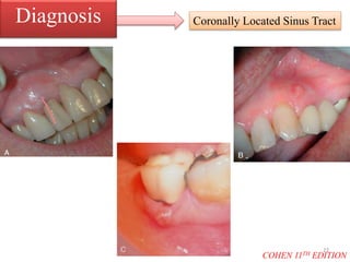 Coronally Located Sinus TractDiagnosis
COHEN 11TH EDITION
22
 