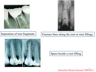 Separation of root fragments Fracture lines along the root or root fillings
Australian Dental Journal 1999;44:2.
25
Space beside a root filling
 
