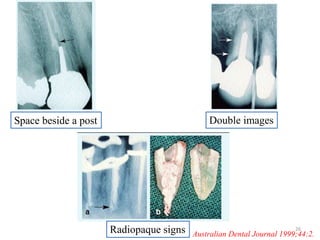 Space beside a post Double images
Radiopaque signs Australian Dental Journal 1999;44:2.
26
 