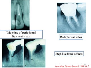 Widening of periodontal
ligament space Radiolucent halos
Step-like bone defects
Australian Dental Journal 1999;44:2.
27
 