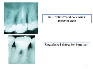 Isolated horizontal bone loss in
posterior teeth
Unexplained bifurcation bone loss
28
 