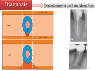 Radiolucency in the Bone Along RootDiagnosis
29
 