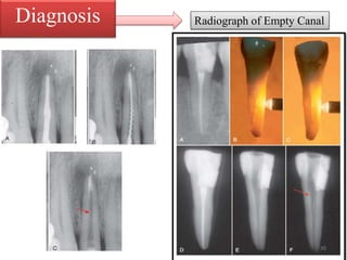 Radiograph of Empty CanalDiagnosis
30
 