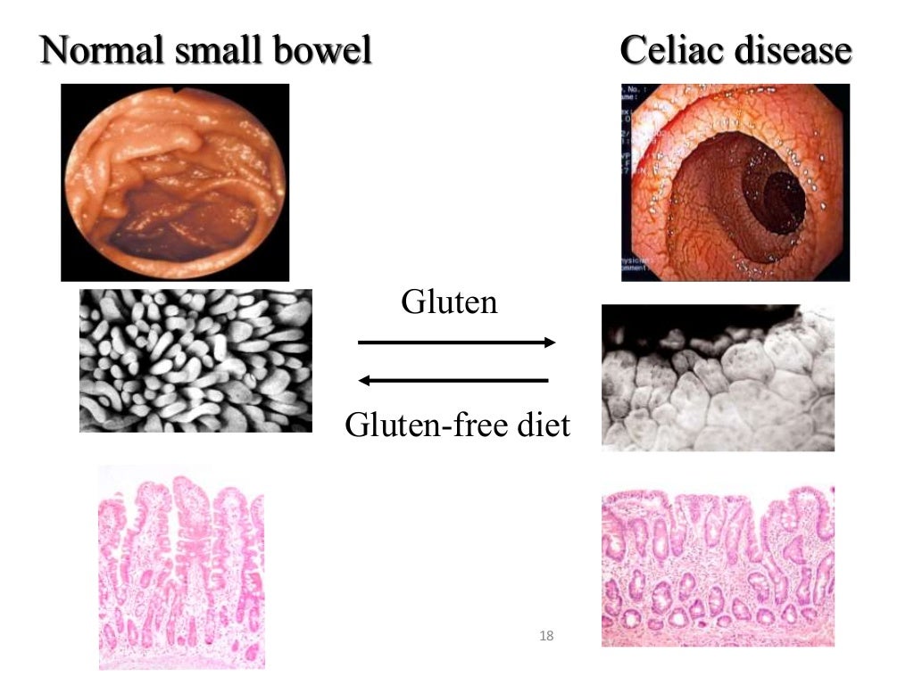 CELIAC DISEASE