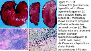 Figure 11: 1.11
Hashimoto’s (autoimmune)
thyroiditis, with diffuse
thyroid enlargement (a)
and a grayish, fleshy cut
surface (b). Microscopy
shows extensive lymphoid
infiltrates with reactive
germinal centers (c). The
follicular cells are large and
contain granular,
eosinophilic cytoplasm (d,
Hürthle cells, arrow).
de Quervain’s thyroiditis is
similar but with
granulomatous infiltrates
 