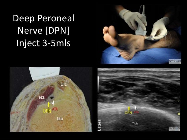 Ultrasound Guided Ankle Block
