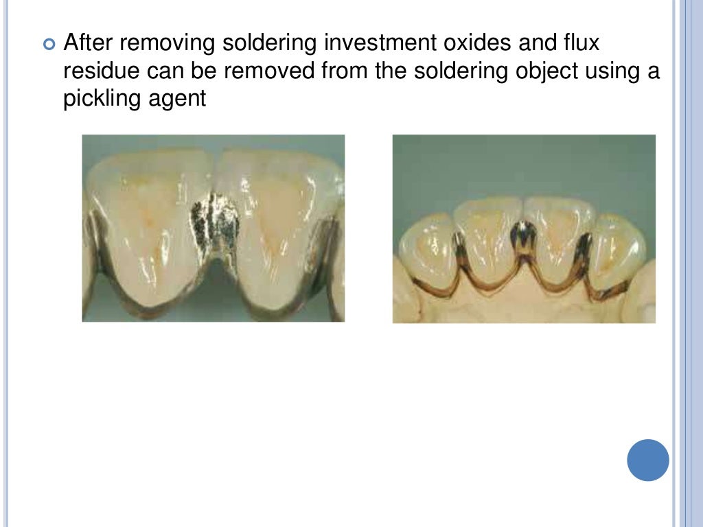 SOLDERINGWELDING AND ITS USE IN PROSTHODONTICS