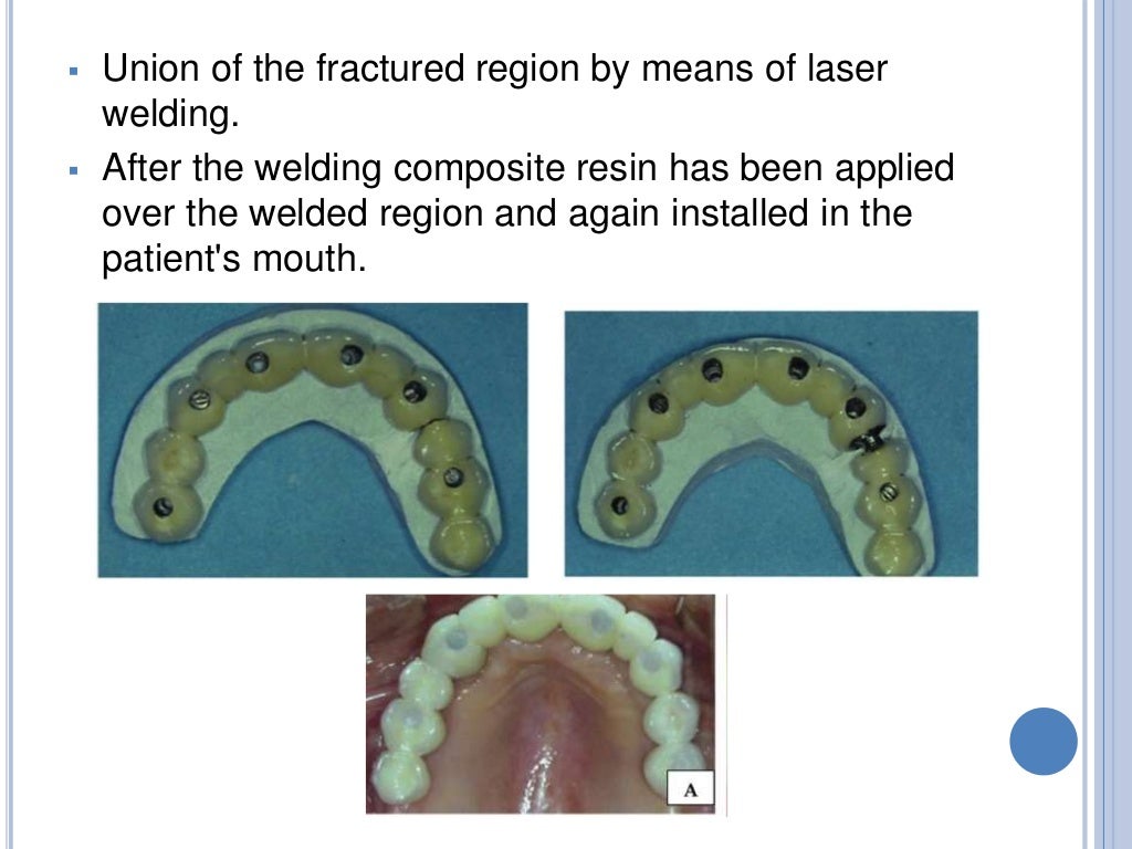 SOLDERINGWELDING AND ITS USE IN PROSTHODONTICS