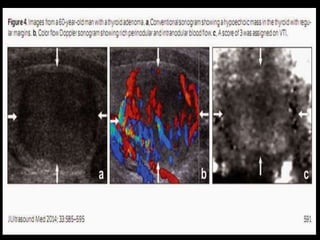 Presentation1.pptx, radiological imaging of the thyroid gland disease…