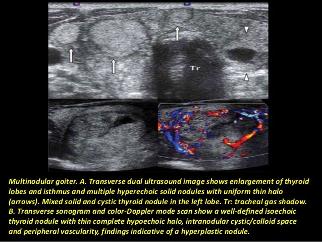 Thyroid lesions detected by mri