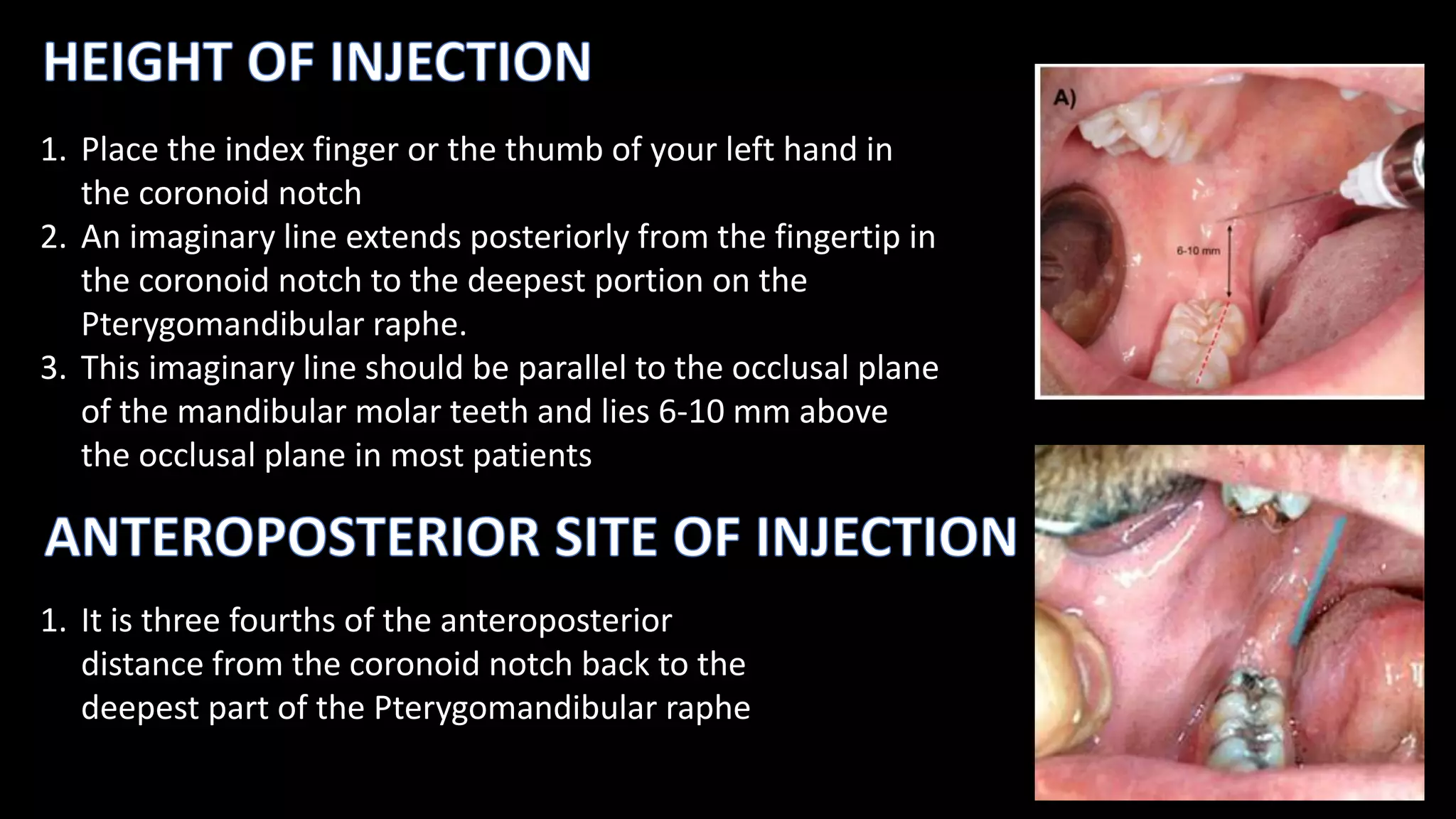 INFERIOR ALVEOLAR NERVE BLOCK