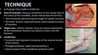 1. A 25 gauge long needle is preferred.
2. Area of insertion : Mucous membrane on the medial side of
the ramus of the mand...