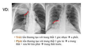 Chẩn đoán hình ảnh U trung thất | PPTX