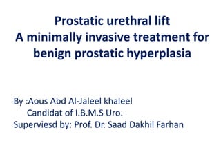 By :Aous Abd Al-Jaleel khaleel
Candidat of I.B.M.S Uro.
Superviesd by: Prof. Dr. Saad Dakhil Farhan
Prostatic urethral lift
A minimally invasive treatment for
benign prostatic hyperplasia
 