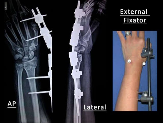 colles fracture intra articular