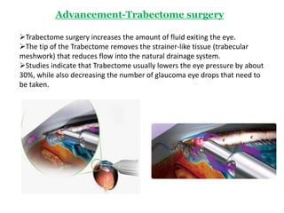 Glaucoma, a major cause of blindness. | PPTX